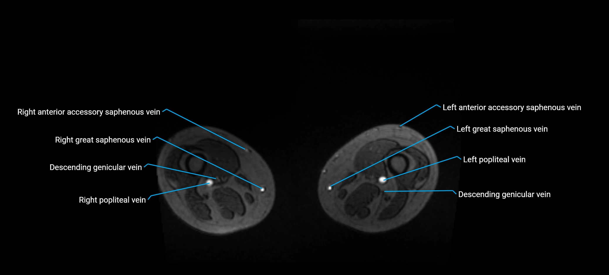 MRV abdomen pelvis & lower limb axial cross sectional anatomy labelled MRI image 320.webp
